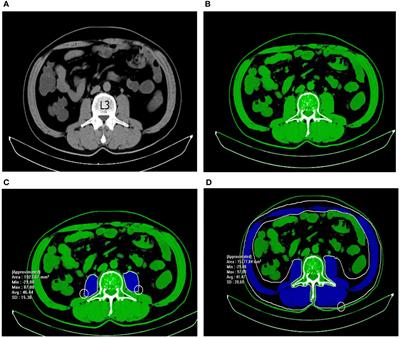 The psoas muscle density as a predictor of postoperative complications in elderly patients undergoing rectal cancer resection